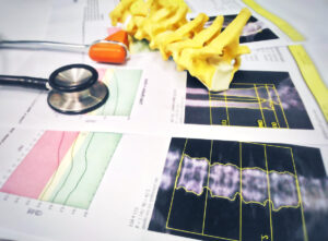 Close up stethoscope spine models Put on a bone Density report.